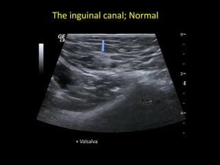 The inguinal canal; Normal
Tub. Pub.
+ Valsalva
 