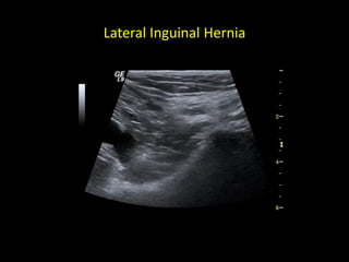 Lateral Inguinal Hernia
 
