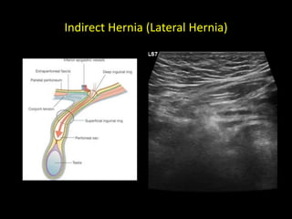 Indirect Hernia (Lateral Hernia)
 