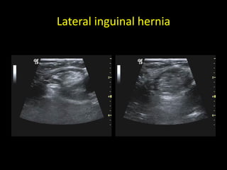 Lateral inguinal hernia
 