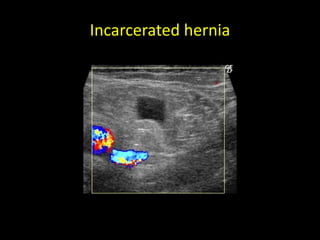 Incarcerated hernia
 