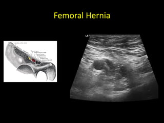 Femoral Hernia
 