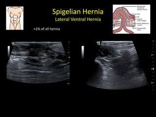 Spigelian Hernia
Lateral Ventral Hernia
≈1% of all hernia
 