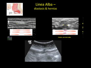 Linea Alba –
diastasis & hernias
 