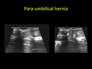 Para-umbilical hernia
 