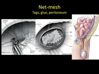 Net-mesh
Tags, glue, peritoneum
 