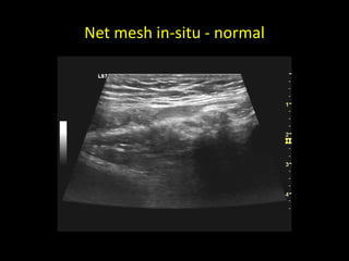 Net mesh in-situ - normal
 