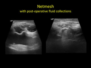 Netmesh
with post-operative fluid collections
 
