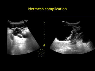 Netmesh complication
 