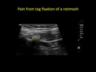 Pain from tag fixation of a netmesh
 