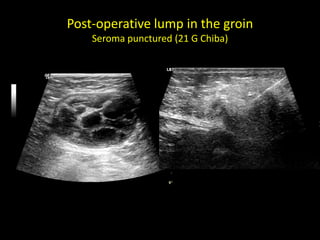Post-operative lump in the groin
Seroma punctured (21 G Chiba)
 