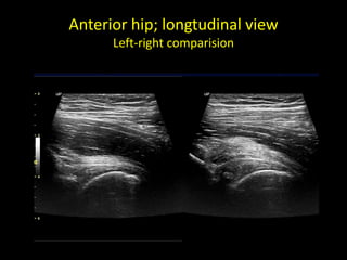 Anterior hip; longtudinal view
Left-right comparision
 