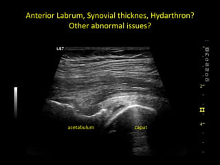 Anterior Labrum, Synovial thicknes, Hydarthron?
Other abnormal issues?
acetabulum caput
 