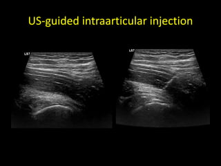 US-guided intraarticular injection
 
