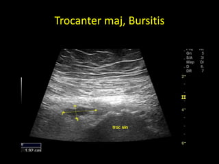 Trocanter maj, Bursitis
 