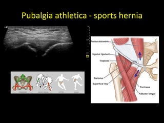 Pubalgia athletica - sports hernia
 