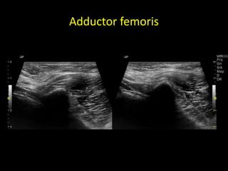Adductor femoris
 