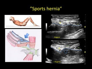 ”Sports hernia”
R
F
R
F
- Bugpres
+ Bugpres
 