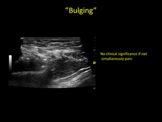 ”Bulging”
No clinical significance if not
simultaneusly pain
 