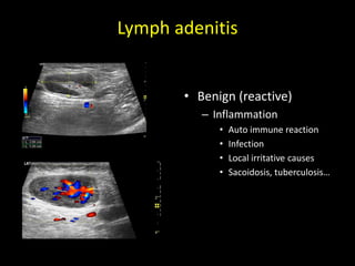 Lymph adenitis
• Benign (reactive)
– Inflammation
• Auto immune reaction
• Infection
• Local irritative causes
• Sacoidosis, tuberculosis…
 