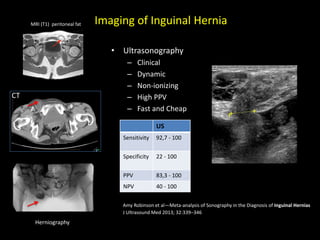 Imaging of Inguinal Hernia
• Ultrasonography
– Clinical
– Dynamic
– Non-ionizing
– High PPV
– Fast and Cheap
MRI (T1) peritoneal fat
Herniography
CT
US
Sensitivity 92,7 - 100
Specificity 22 - 100
PPV 83,3 - 100
NPV 40 - 100
Amy Robinson et al—Meta-analysis of Sonography in the Diagnosis of Inguinal Hernias
J Ultrasound Med 2013; 32:339–346
 