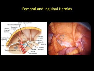 Femoral and Inguinal Hernias
 
