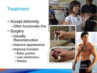 Treatment
• Accept deformity
–Often functionally fine
• Surgery
–Usually
Reconstruction
–Improve appearance
–Improve function
• Better position
• Less interference
• Stability
Dr Amy Khor,
Senior Minister
of State for
Health
Hrithik
Roshan
 