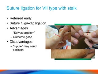 Suture ligation for VII type with stalk
• Referred early
• Suture / liga-clip ligation
• Advantages
– “Solves problem”
– Outcome good
• Disadvantages
– “nipple” may need
excision
 