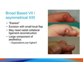 Broad Based VII /
asymmetrical II/III
• “Easiest”
• Excision with small local flap
• May need radial collateral
ligament reconstruction
• Large component of
aesthetics:
– Expectations are higher!!
 