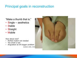 Principal goals in reconstruction
“Make a thumb that is:”
• Single -- aesthetics
• Stable
• Straight
• Mobile
How about size?
• Perfect match not needed
• Too small a nail
• Angulation at IPJ bigger problem
Goldfarb 2006, JHSA
 