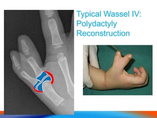 Typical Wassel IV:
Polydactyly
Reconstruction
 