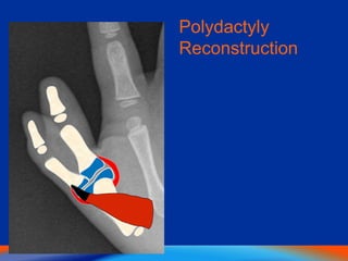 Polydactyly
Reconstruction
 