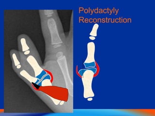 Polydactyly
Reconstruction
 
