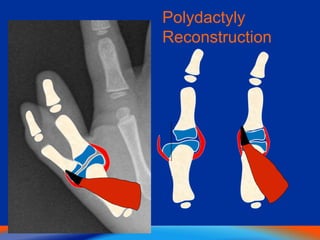 Polydactyly
Reconstruction
 