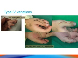 Type IV variations
IV divergent type
IV deficient skin on radial side
 