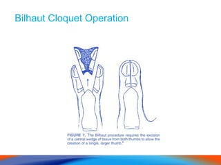 Bilhaut Cloquet Operation
 