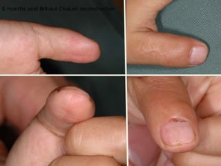 6 months post Bilhaut Cloquet reconstruction
 