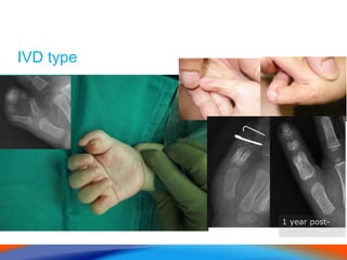 IVD type
1 year post-
operation
 