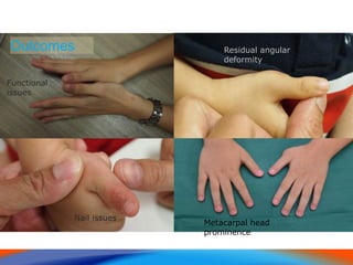 Nail issues
Outcomes Residual angular
deformity
Metacarpal head
prominence
Functional
issues
 