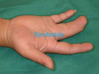 Syndactyly
 