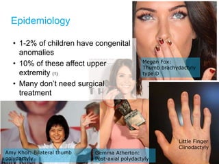 Megan Fox:
Thumb brachydactyly
type D
Epidemiology
• 1-2% of children have congenital
anomalies
• 10% of these affect upper
extremity (1)
• Many don’t need surgical
treatment
Little Finger
Clinodactyly
Gemma Atherton:
Post-axial polydactyly
Amy Khor: Bilateral thumb
polydactyly
 