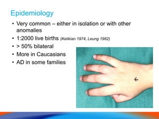 Epidemiology
• Very common – either in isolation or with other
anomalies
• 1:2000 live births (Kelikian 1974, Leung 1982)
• > 50% bilateral
• More in Caucasians
• AD in some families
 