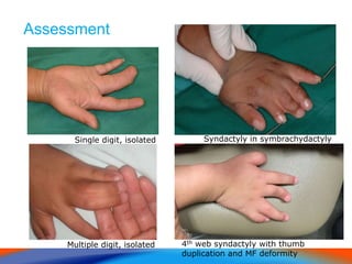 Assessment
• , or brachydactyly).
Single digit, isolated
Multiple digit, isolated
Syndactyly in symbrachydactyly
4th web syndactyly with thumb
duplication and MF deformity
 