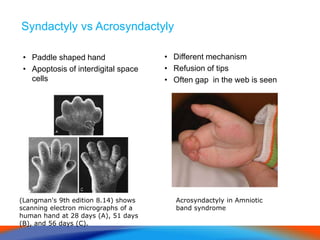 Syndactyly vs Acrosyndactyly
• Paddle shaped hand
• Apoptosis of interdigital space
cells
• Different mechanism
• Refusion of tips
• Often gap in the web is seen
Acrosyndactyly in Amniotic
band syndrome
(Langman's 9th edition 8.14) shows
scanning electron micrographs of a
human hand at 28 days (A), 51 days
(B), and 56 days (C).
 