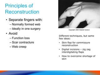 Principles of
Reconstruction
• Separate fingers with:
– Normally formed web
– Ideally in one surgery
• Avoid
– Function loss
– Scar contracture
– Web creep
Different techniques, but same
few ideas:
• Skin flap for commissure
reconstruction
• Digital incisions – zig zag
interdigitating flaps
• How to overcome shortage of
skin
 