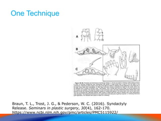 One Technique
Braun, T. L., Trost, J. G., & Pederson, W. C. (2016). Syndactyly
Release. Seminars in plastic surgery, 30(4), 162-170.
https://www.ncbi.nlm.nih.gov/pmc/articles/PMC5115922/
 