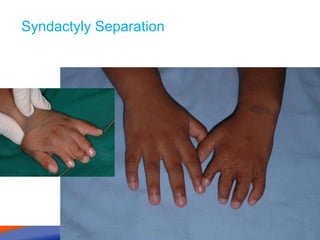 Syndactyly Separation
 