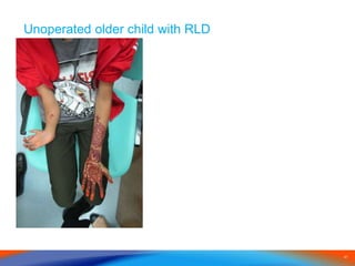 41
Unoperated older child with RLD
 