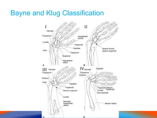 Bayne and Klug Classification
II II
III IV
 