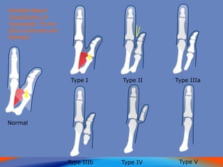 Normal
Type I Type II Type IIIa
Type IIIb Type IV Type V
Modified Blauth
Classification of
Hypoplastic Thumb
(Buck-Gramcko and
Manske)
 